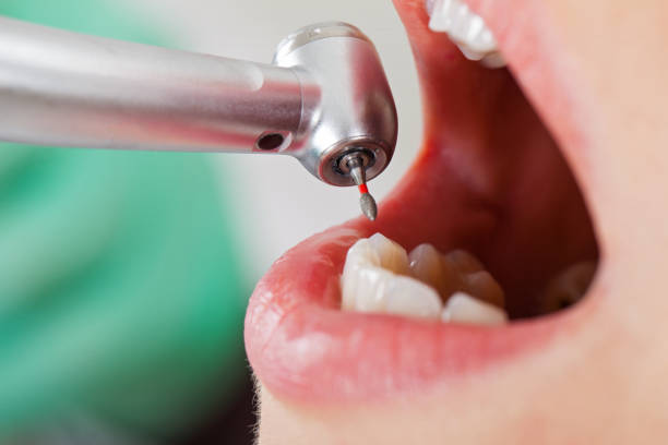 Best Emergency Tooth Extraction in Woodbury, TN